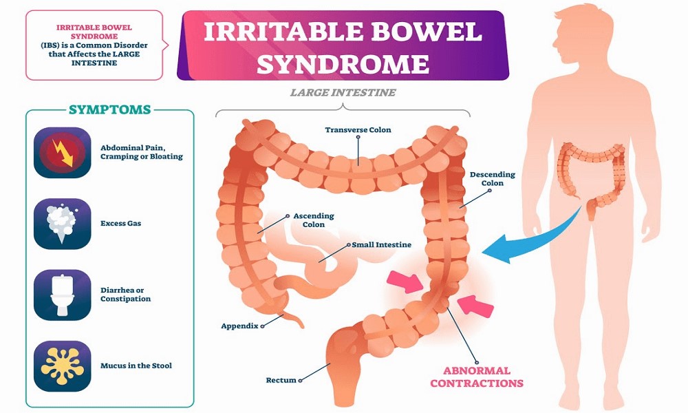 Irritable Bowel Syndrome 2